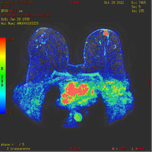 Magnetic Mammography