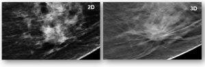 breast tomosynthesis