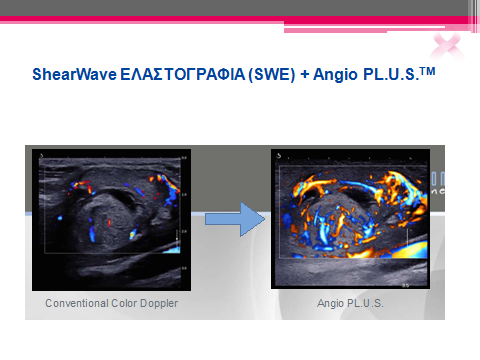 ULTRASOUND SHEARWAVE ELASTOGRAPHY